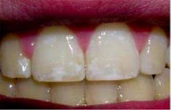 Mild dental fluorosis